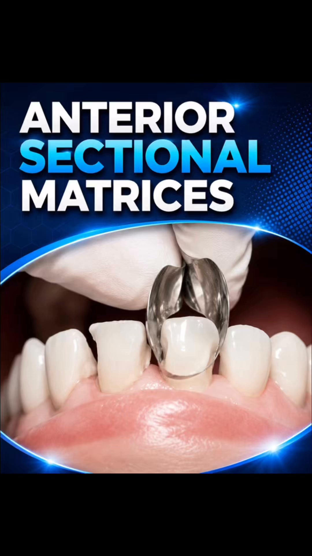 Anterior Sectional Matrices —Natural Contours. Less Finishing Time.