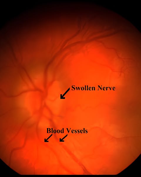 I Was Diagnosed With IIH At 32 After A Spinal Tap. I'm 40 Now. My Neuro-Ophthalmologist Never Asked Me About The Headaches I Had Before The