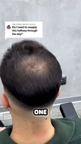 Seeing More Scalp Lately?