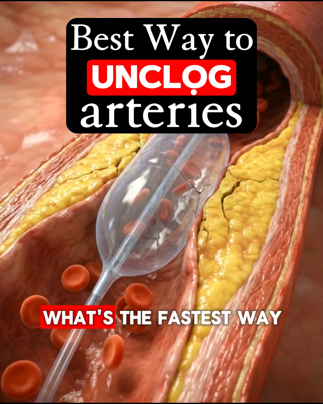 Got Artery Plaque? What Are You Waiting For?