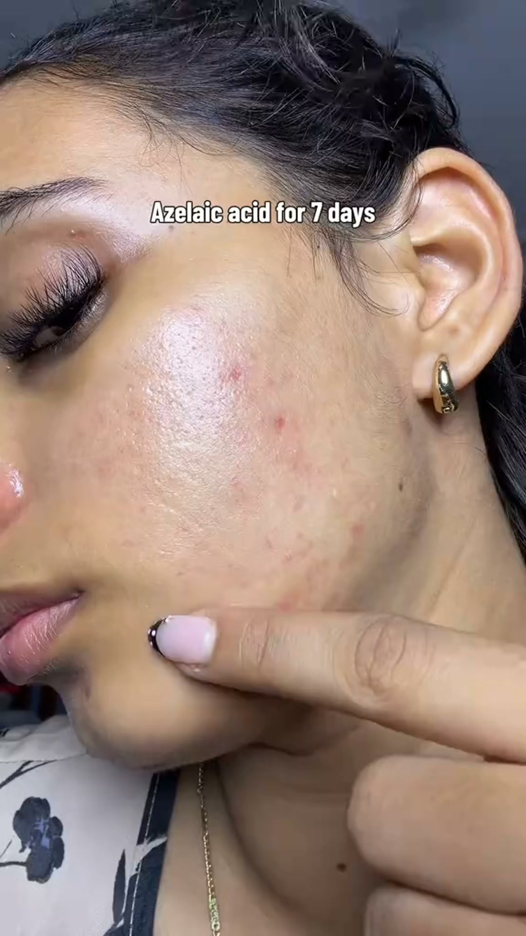 Calmer, Clearer-Looking Skin