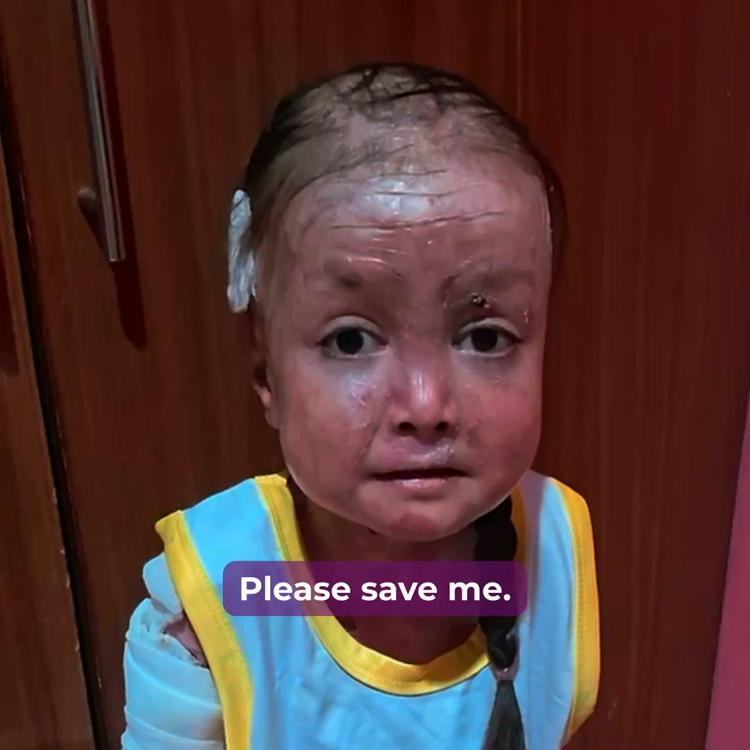 Shamila’s Skin Is Falling Off. Help Her.