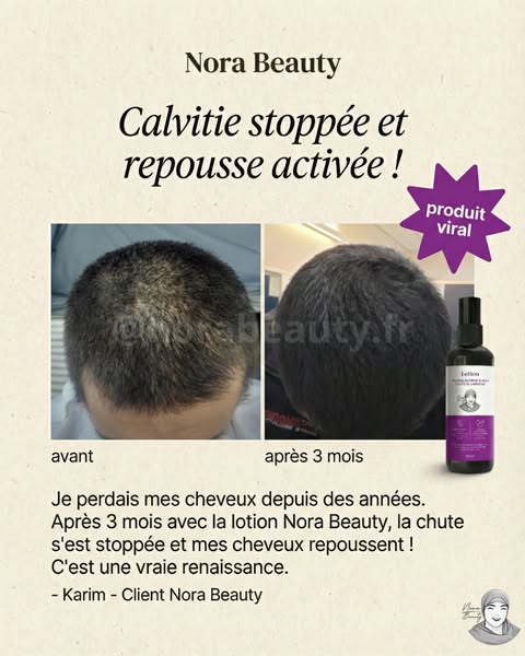 Calvitie : agir dès les premiers signes