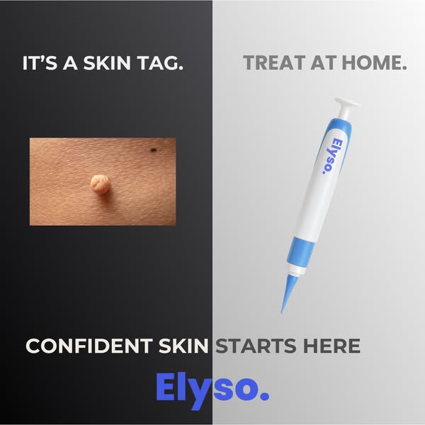 60% OFF Skin Tag Solution
