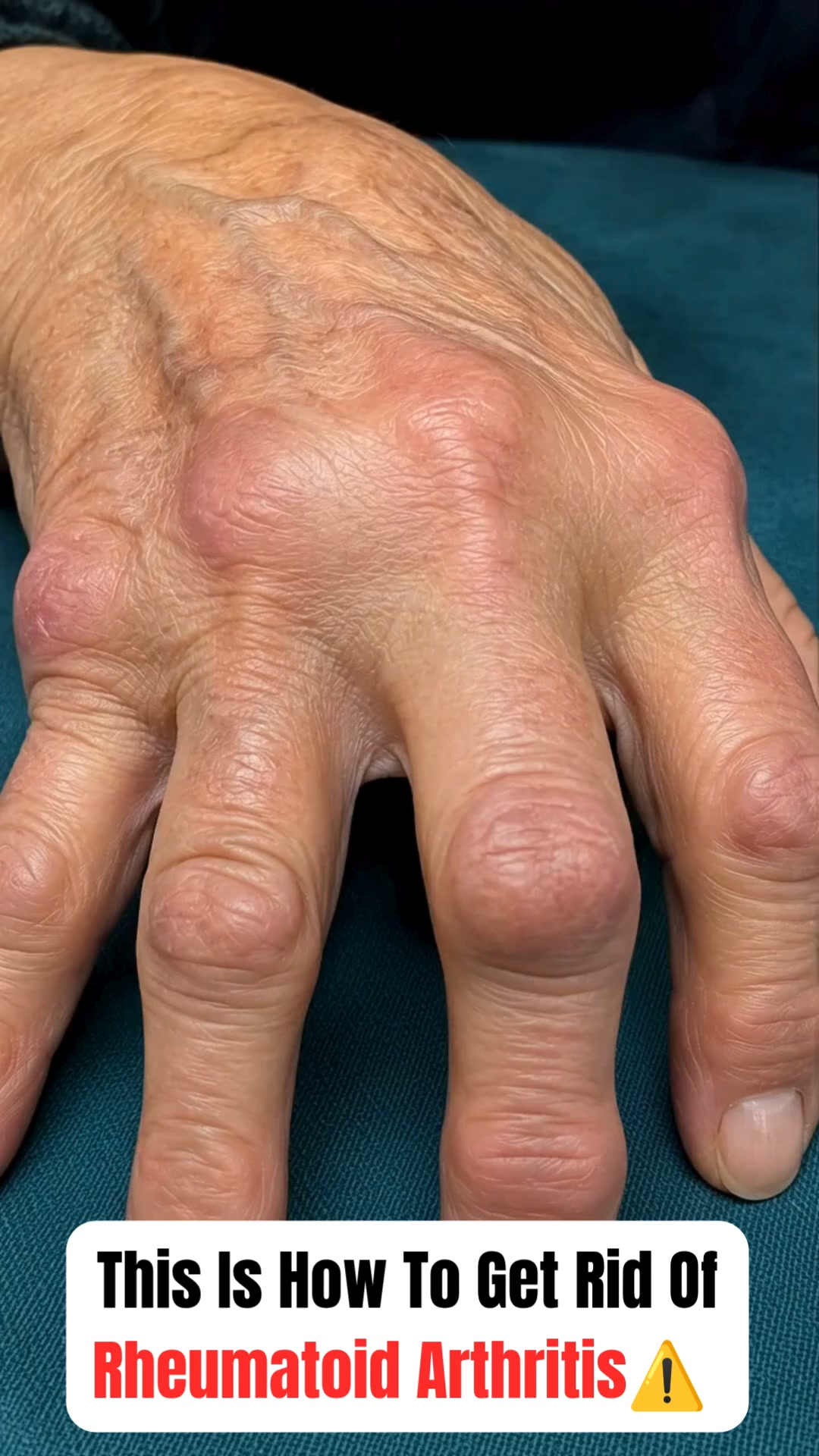 The truth about rheumatoid arthritis