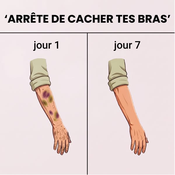 Ta peau marque au moindre choc ?