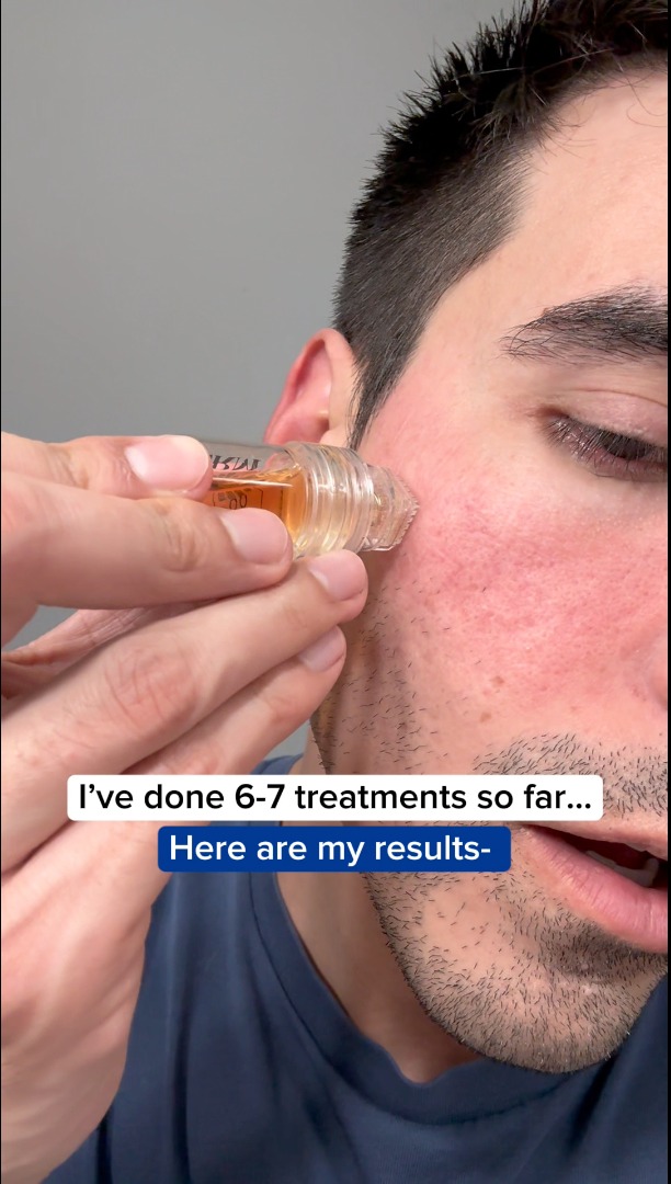 I Stopped Thinking About My Acne Scars