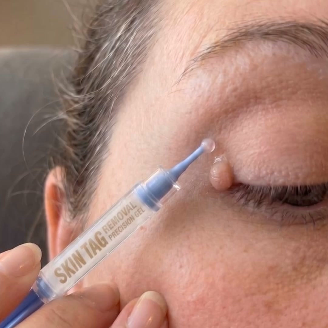 The Painless Way to Remove Skin Tags in 5 Days