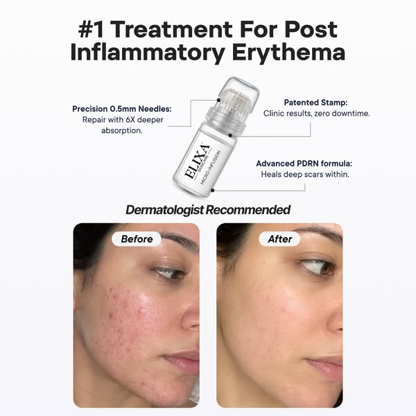 Salmon DNA Heals Acne Scars