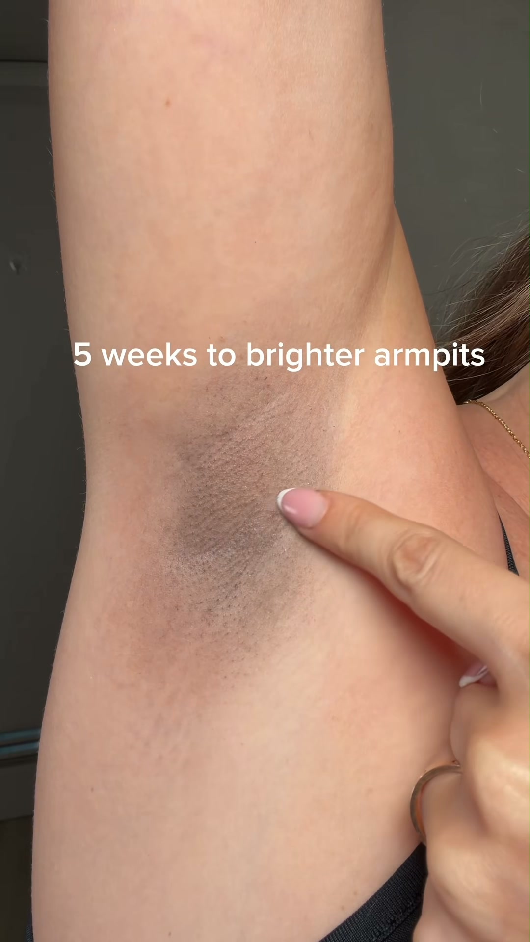 Dark Spots Gone In 2 Weeks