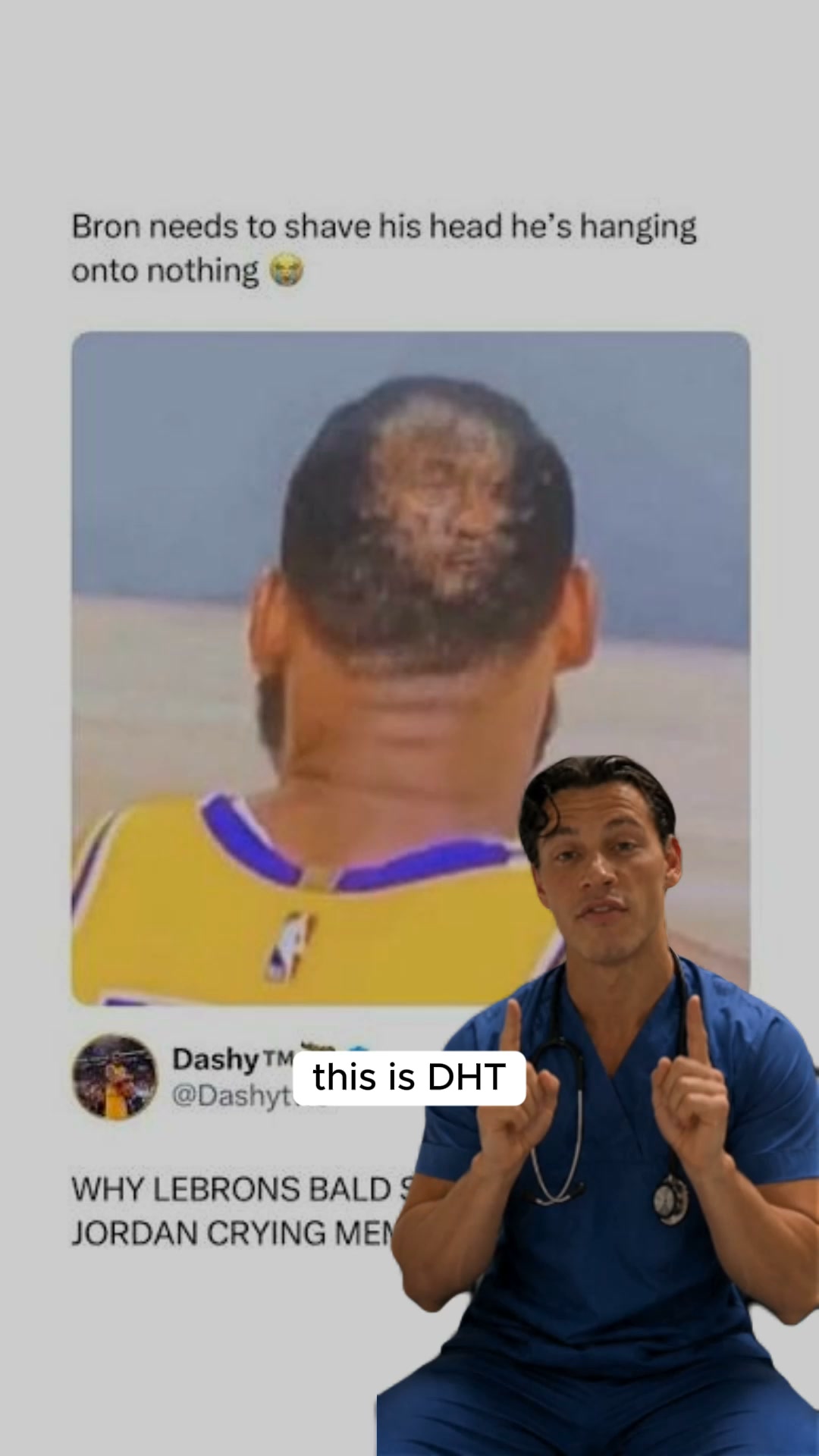 DHT Is Shrinking Your Follicles. Here Is How to Block It Naturally.