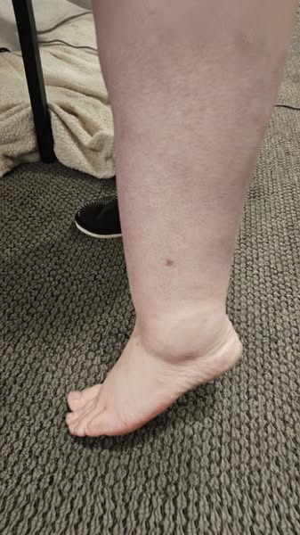 Always burning feet