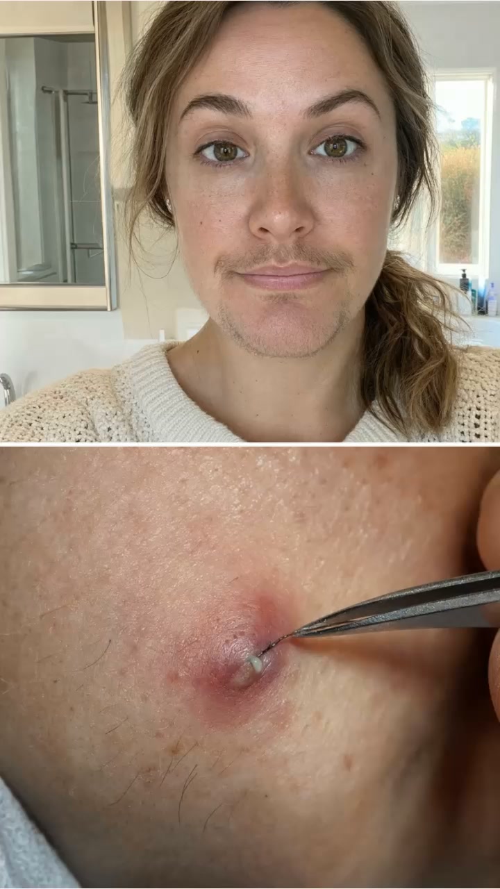 Damenbart? Hör auf zu rasieren, zupfen oder Lasern!