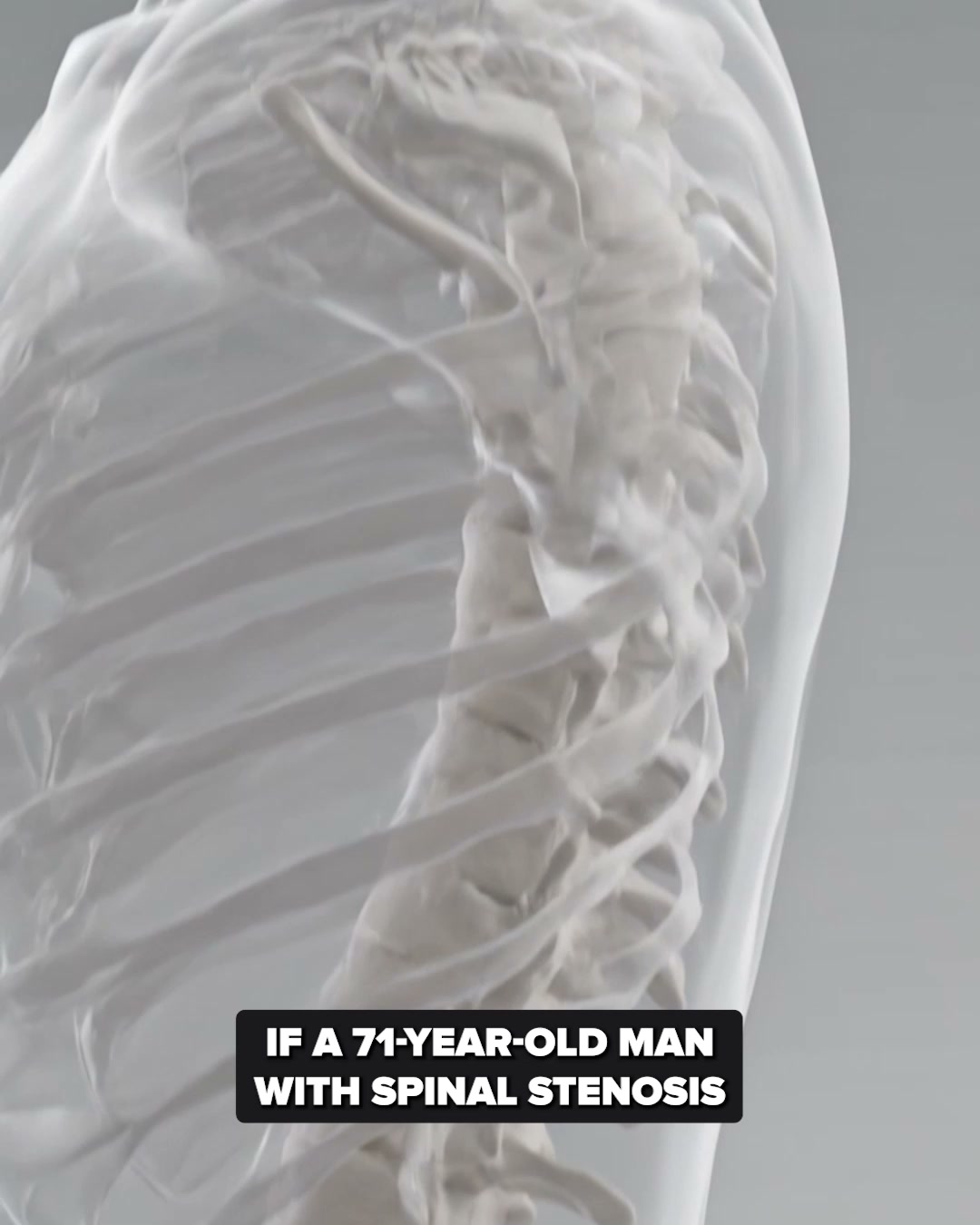 The 3 Stages Of Spinal Stenosis Most Patients Recognize Too Late