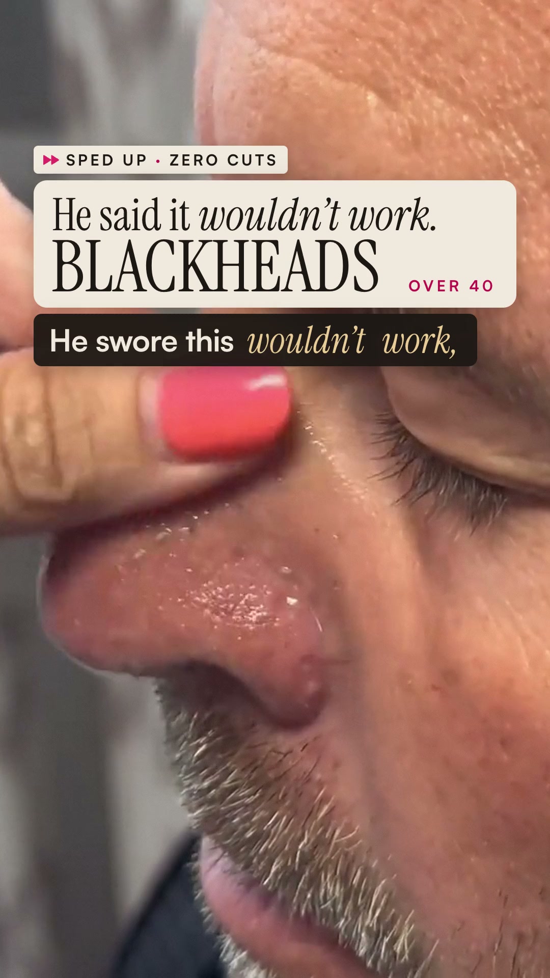 Say goodbye to blackheads