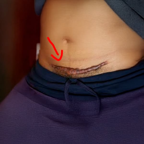 I Stopped Dressing Around My C-Section Scar
