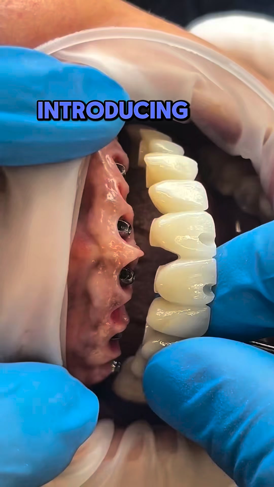 ALL implant brands in 1 compact Kit