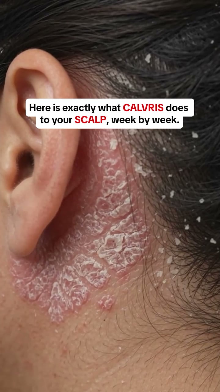 Still itching? It's not dry skin — it's fungus living on your face