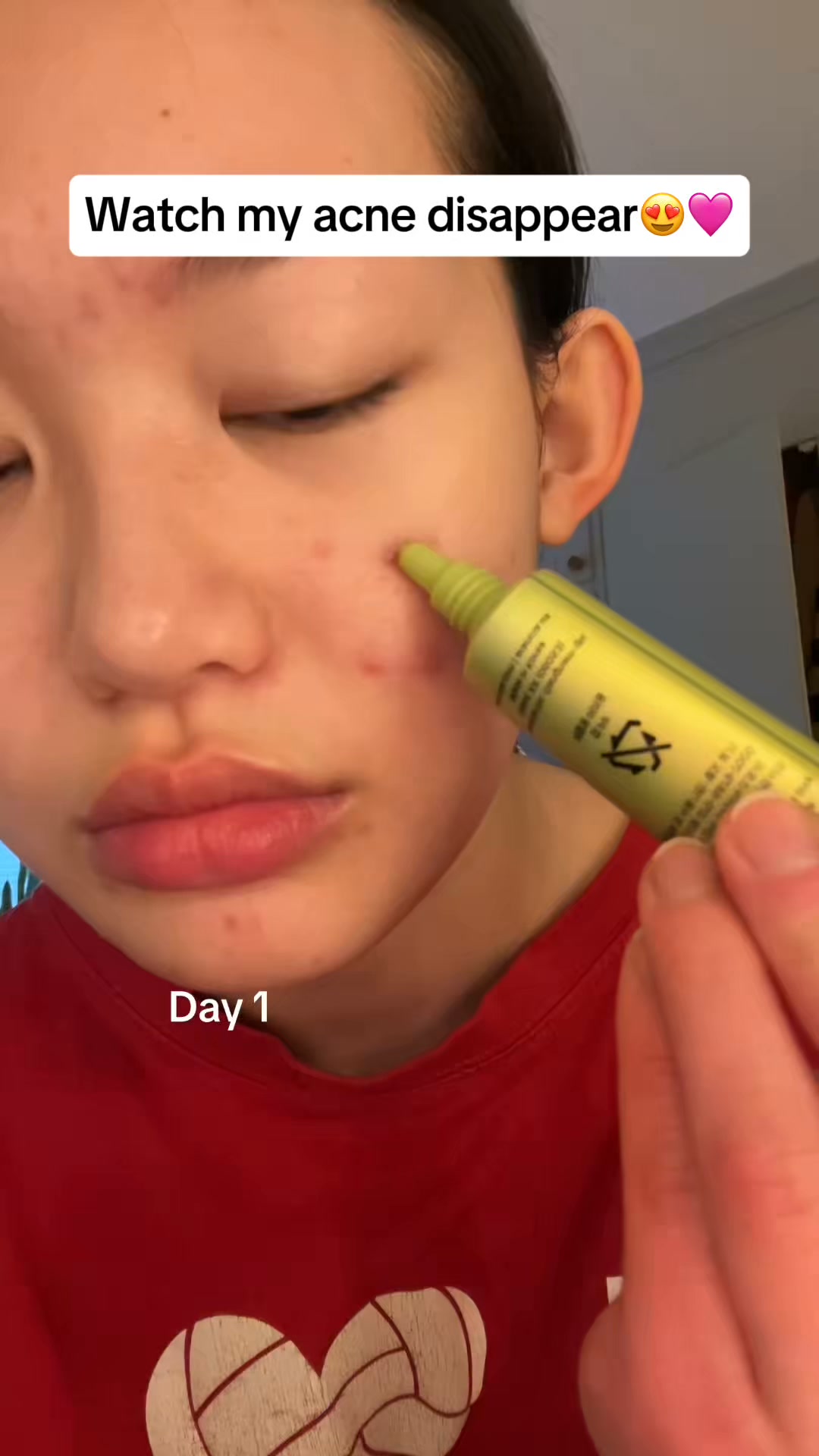 Antioxidant Care for Dark Spots + Post-Acne Marks