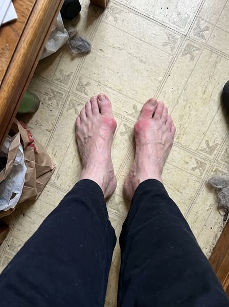 It won't straighten your toe