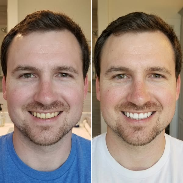 The 2-Minute Whitening Trick That Works