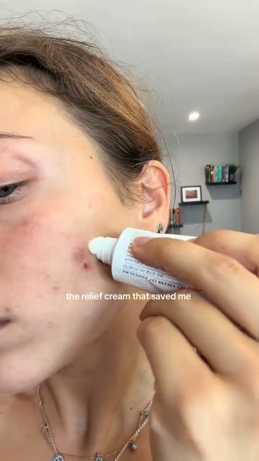 The Korean Answer To Acne’s Aftermath