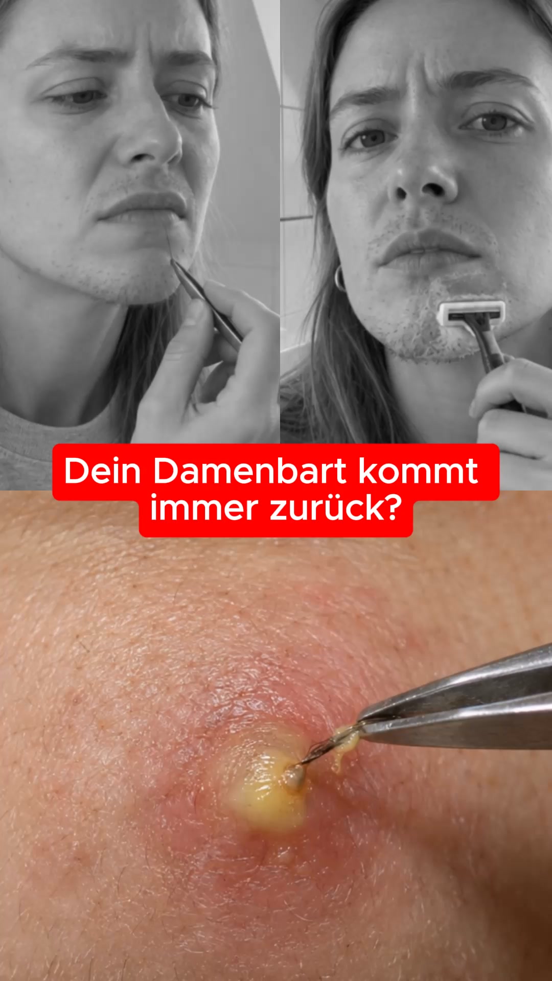 Damenbart? Hör auf zu rasieren, zupfen oder Lasern!