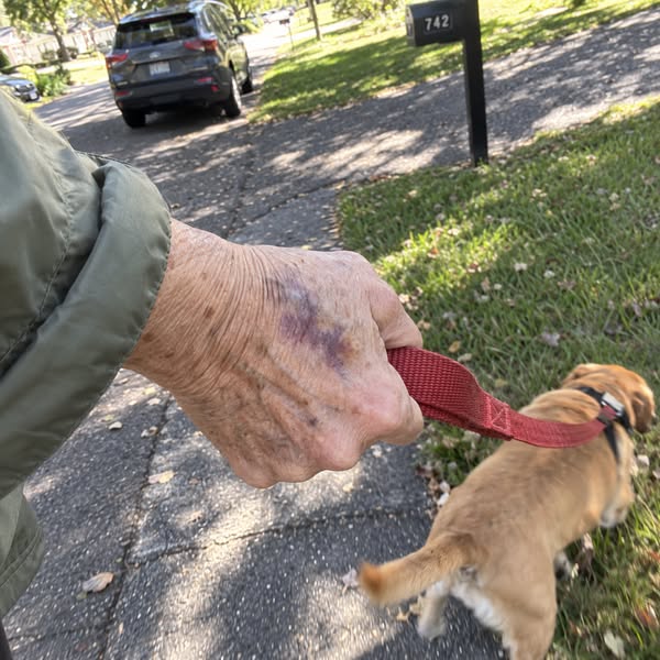 Read this if you wake up to bruises you cannot explain