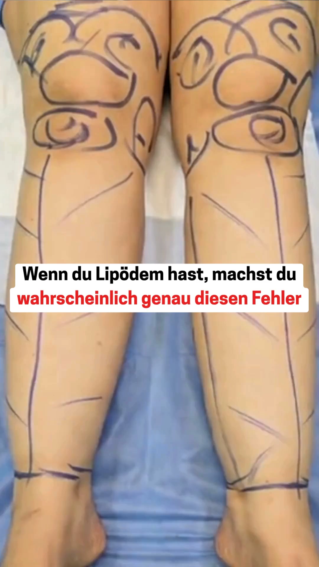 Der Lipödem-Fehler Nr. 1