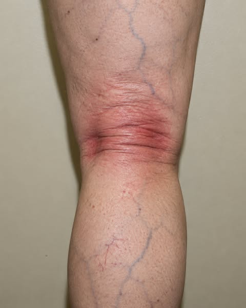 Read This If Your Knee Hyperextends.