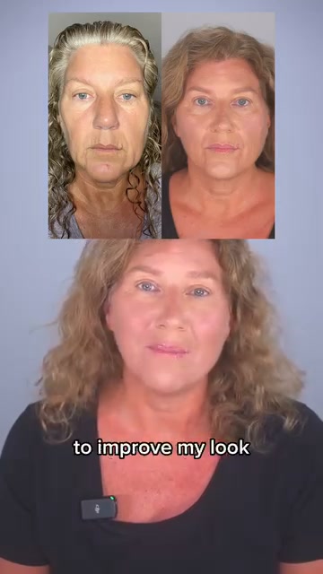 Hooded eyes, Smile lines, Jowls, Eye bags, Double chin