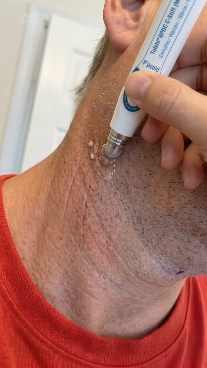 Last Day DiscountAurethix® Botanical Spot & Tag Precision RollPen