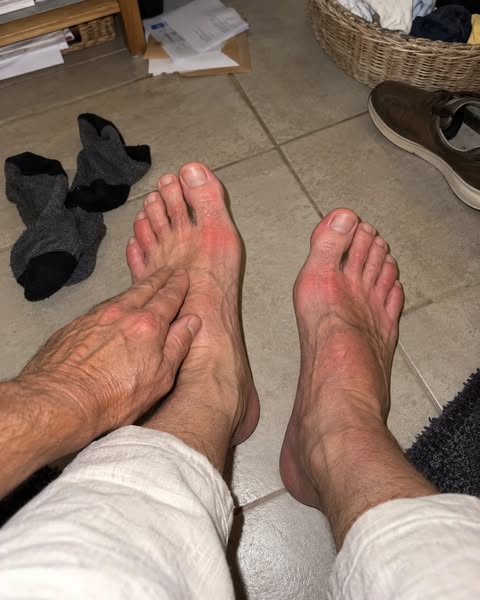 Pieds qui chauffent : la vraie cause