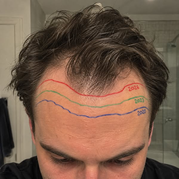His Hairline Changed. So I Finally Asked.
