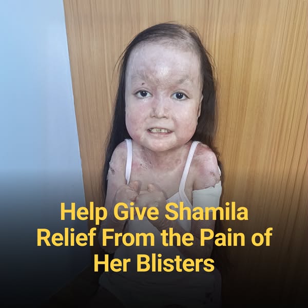 Shamila’s Skin Is Falling Off. Help Her.