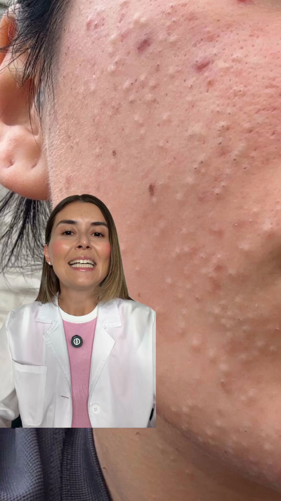 Scopri i 4 step se hai l'acne comedonica