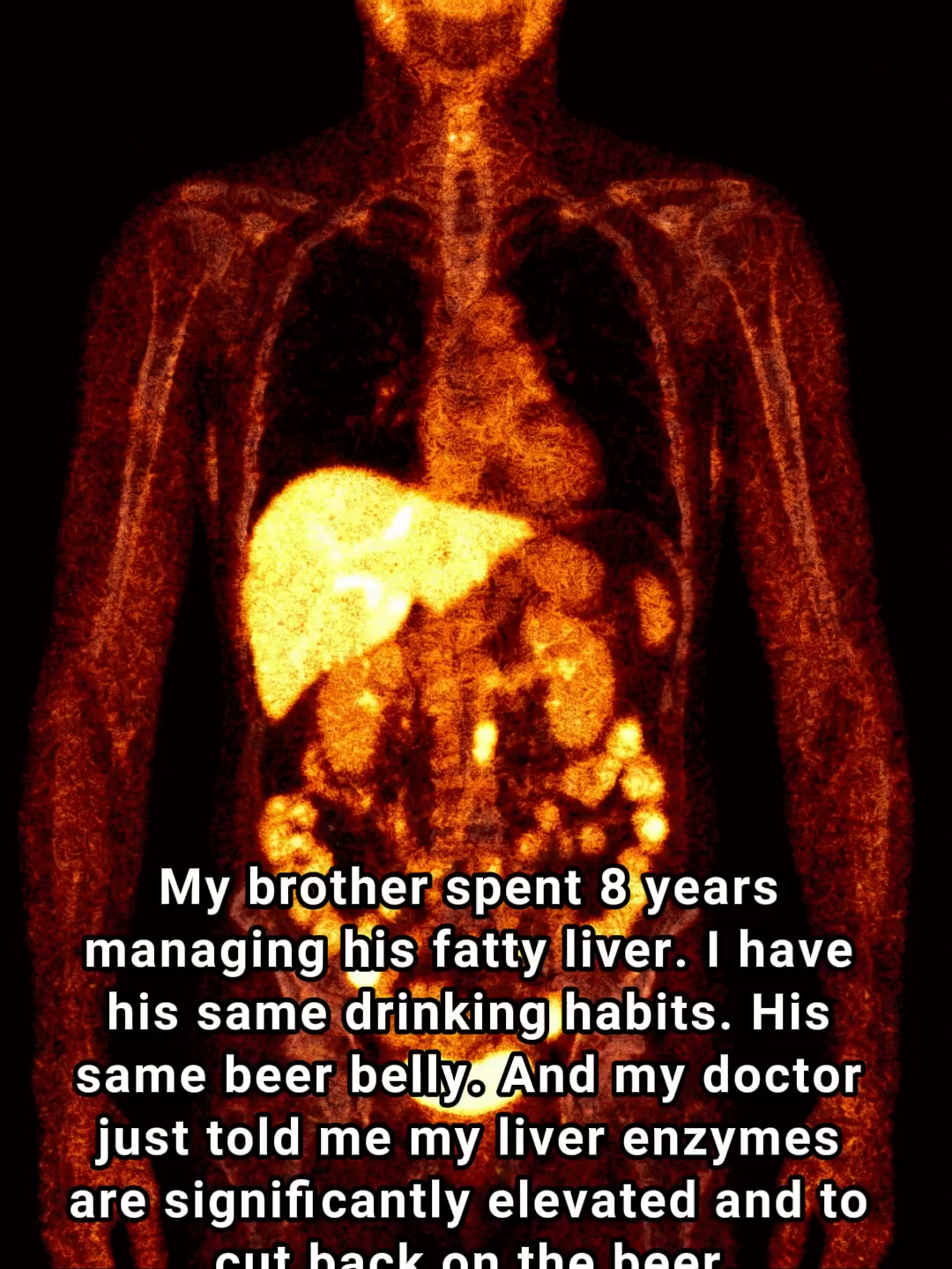 Fatty liver killed my brother. I reversed mine in 8 weeks.