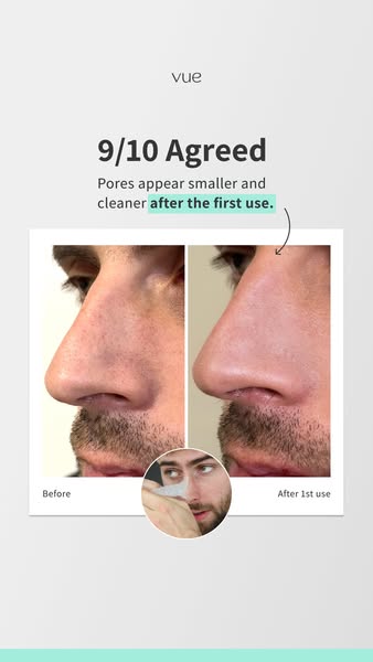 From Oily Nose to Clear Skin