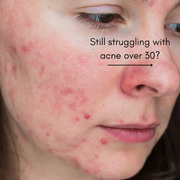 Adult Acne Treatment Here