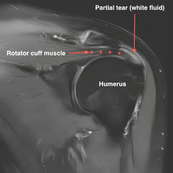 Read This If Your Getting Rotator Cuff Surgery
