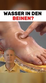 Schwellungen natürlich lindern
