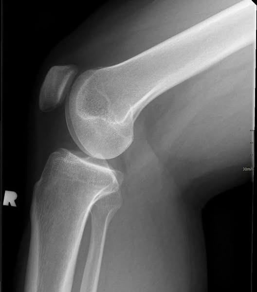 Der wahre Grund, warum so viele Frauen durch die Wechseljahre Arthrose entwickeln.