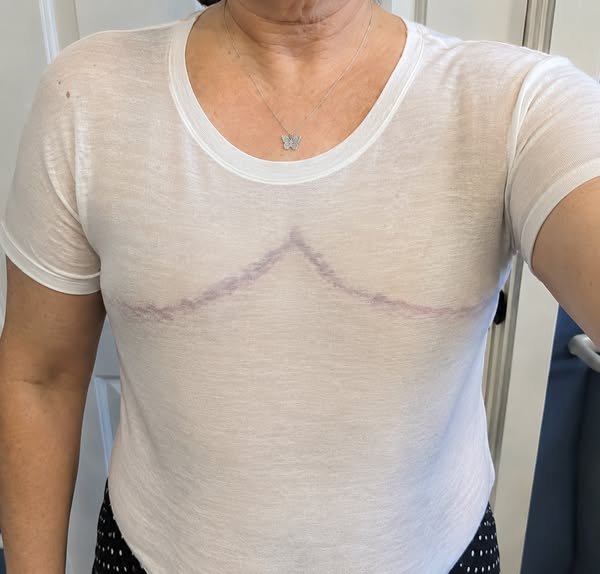 post-mastectomy? read this...