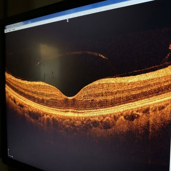 Fight Back Against Macular Degeneration!