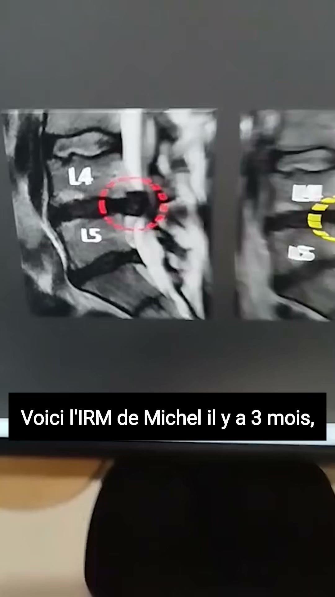 La sciatique chronique peut-elle se traiter en moins de 2 semaines ?