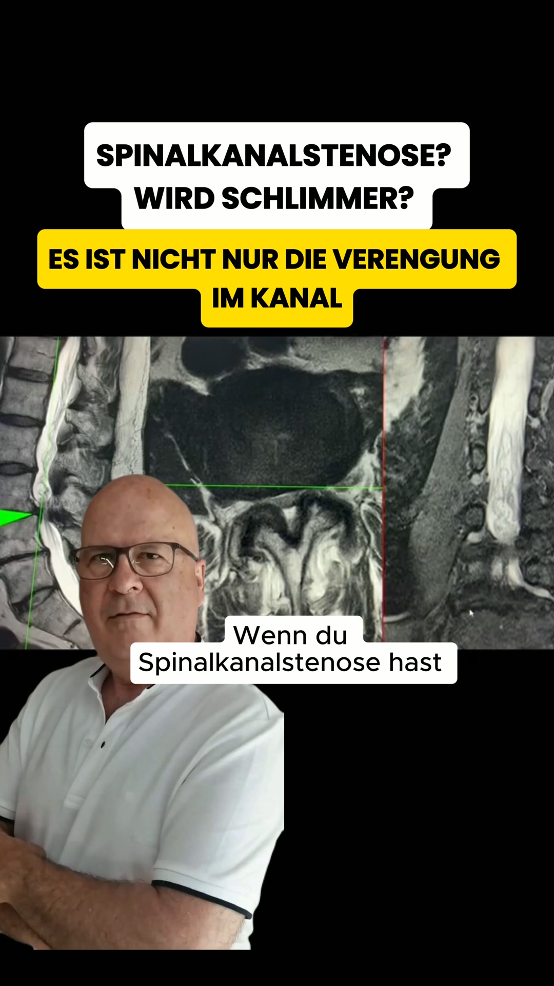 Die wahre Ursache hinter deiner Spinalkanalstenose