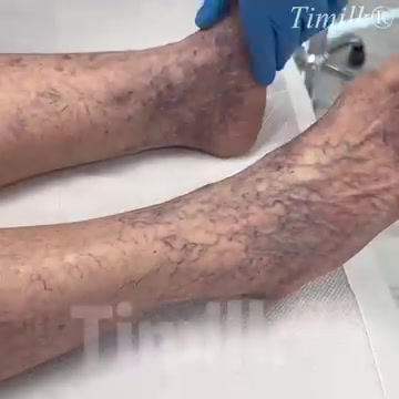 Shrink Varicose Veins Without Surgery