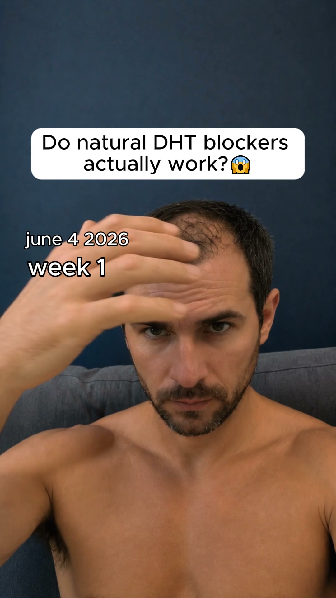 DHT Is Shrinking Your Follicles. Here Is How to Block It Naturally.