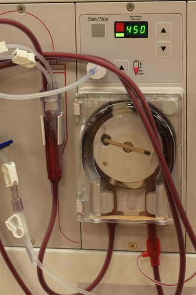 The most dangerous sign of kidney damage is not what you think
