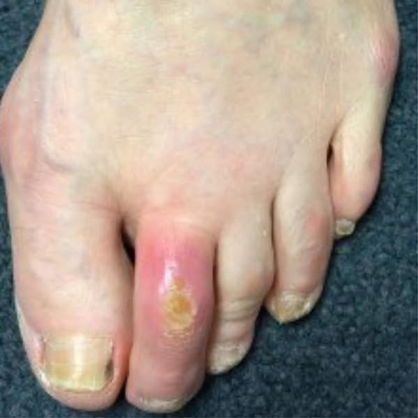 Hammertoe Treatment
